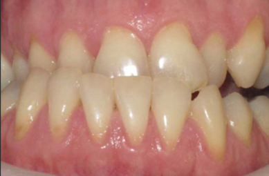 Crossbite