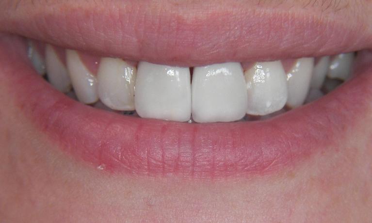 Anterior-Crowns-After-Image