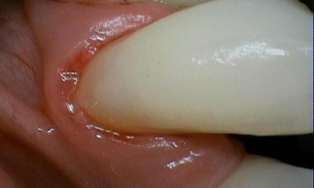 Composite-Restoration-After-Image