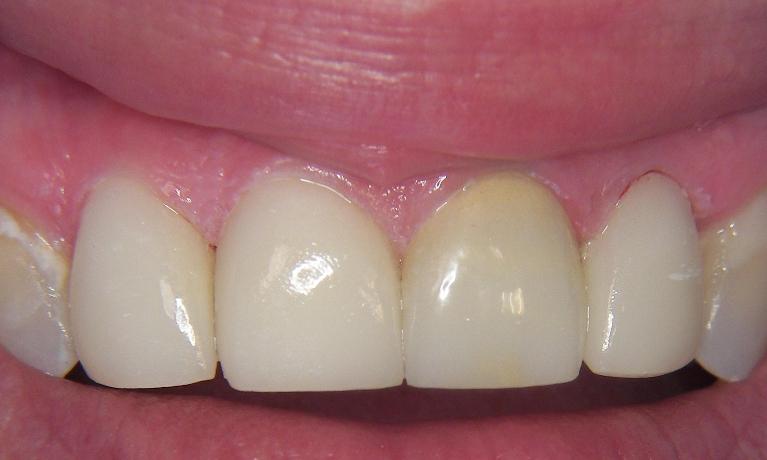 Crowns-After-Image