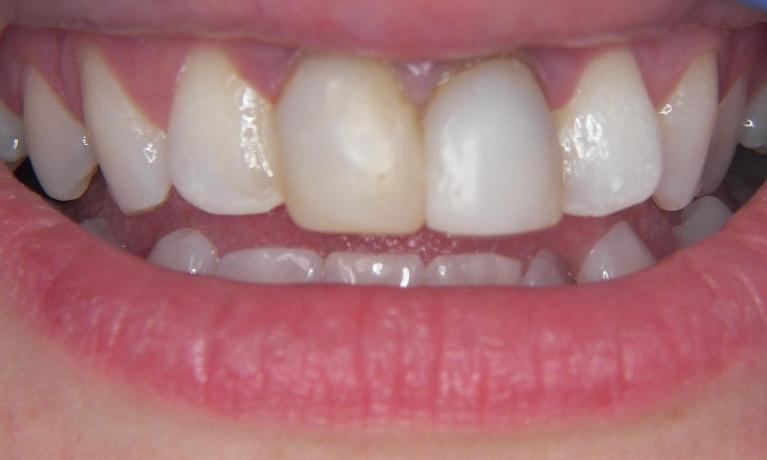 Anterior-Crowns-Before-Image