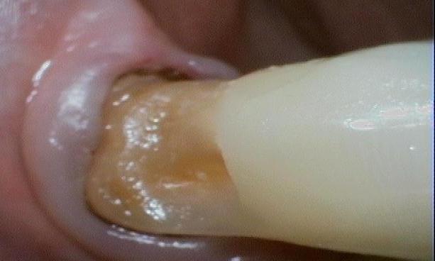 Composite-Restoration-Before-Image