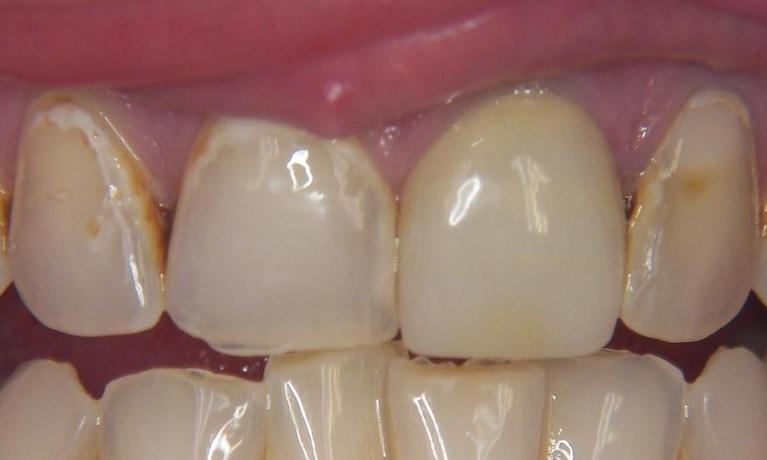 Crowns-Before-Image
