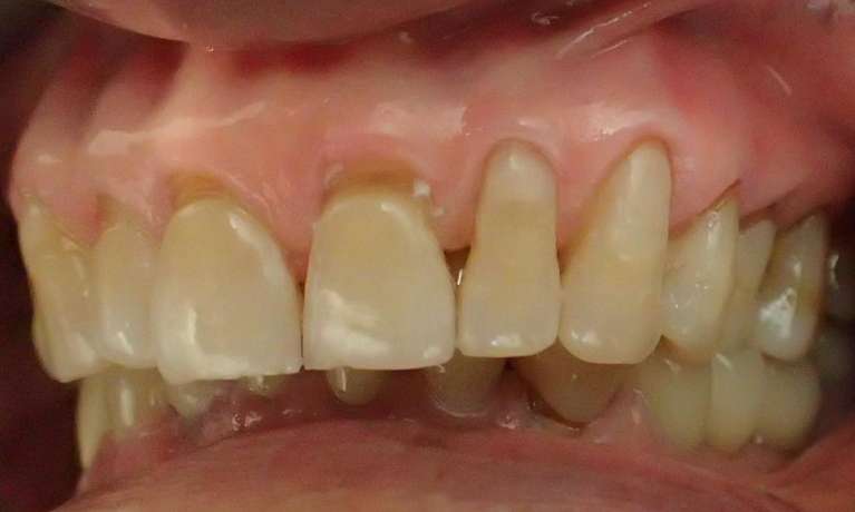 Fillings-for-Worn-Teeth-After-Image