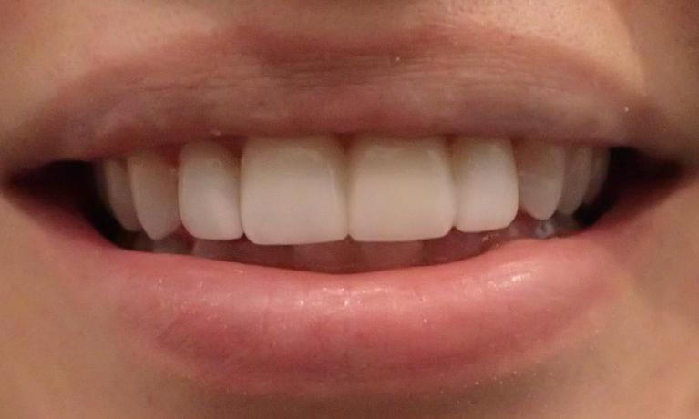 No-Prep-Veneers-After-Image