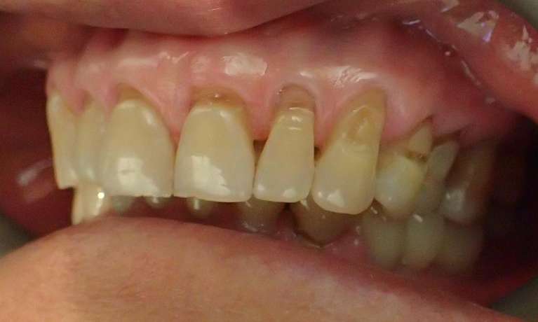 Fillings-for-Worn-Teeth-Before-Image
