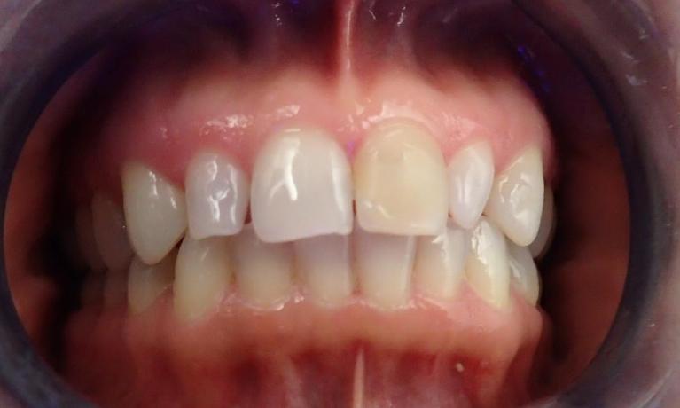 No-Prep-Veneers-Before-Image